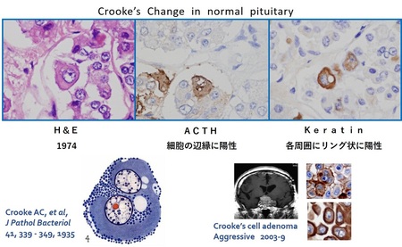 Crooke Change in normal pituitary.jpg
